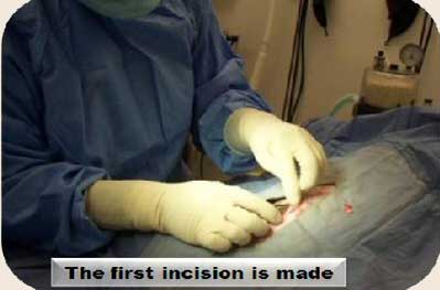 First-Surgical-Incision-16